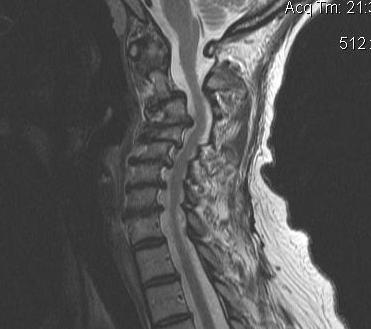 Cervical Myelopathy MRI